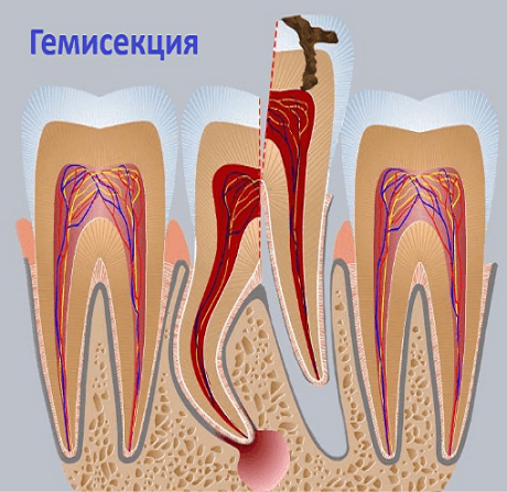 Гемисекция зуба