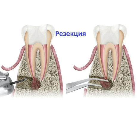 Резекция зуба