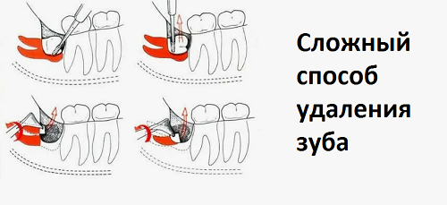 Сложный способ удаления зуба